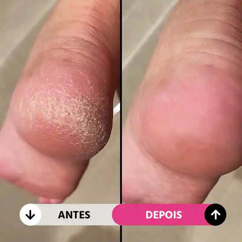Lixa de Pé Elétrica Portátil Removedor de Calos e Rachaduras CallusCare Mega Certo