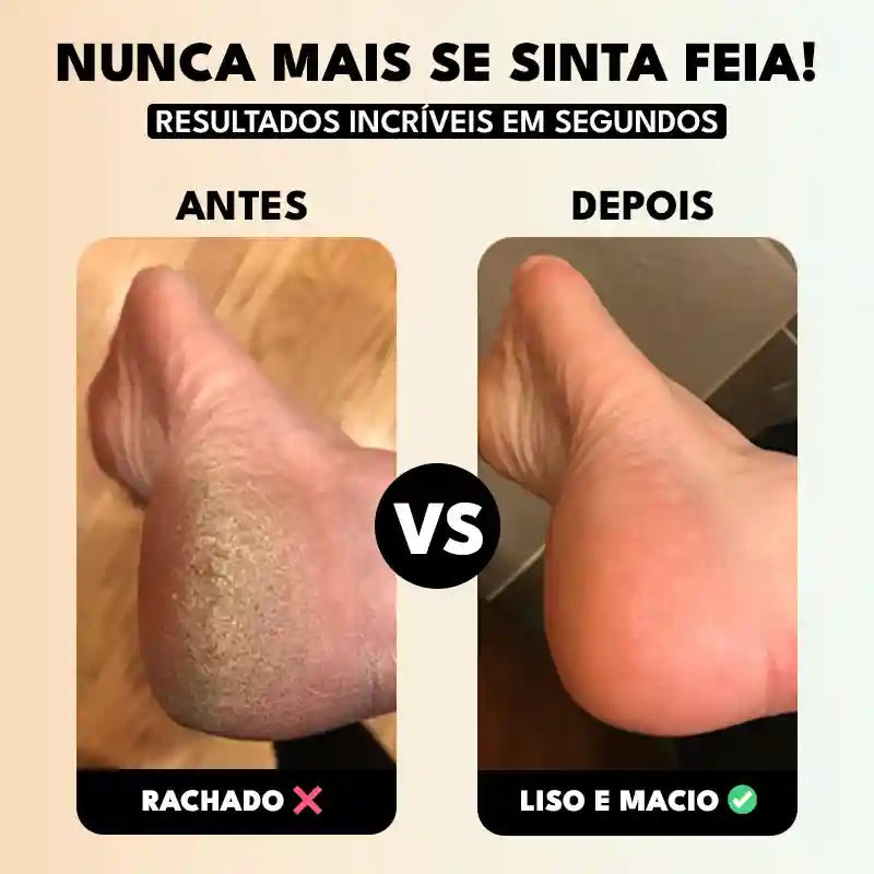 Lixa de Pé Elétrica Portátil Removedor de Calos e Rachaduras CallusCare Mega Certo